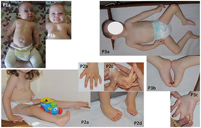 Case Report: Further Delineation of Neurological Symptoms in Young Children Caused by Compound Heterozygous Mutation in the PIEZO2 Gene